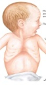 BLES Versus Curosurf for Treatment of Respiratory Distress in Preterm Neonates and Their Adverse Effects