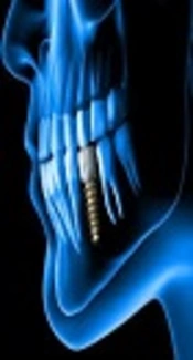A Comparison of Stress Distribution Around Dental Implants in Three Models of Arch Form to Replace Six Anterior Teeth of Maxilla using the Finite Element Analysis (FEA) Method