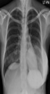 Benign Phyllodes Tumor of the Breast Recurring as a Rapidly Growing Recurrent Malignant Phyllodes Tumor: A Case Report