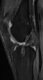 The Effect of Anterior Cruciate Ligament Reconstruction Technique on Graft Signal Intensity at Mid-Term Follow-Up