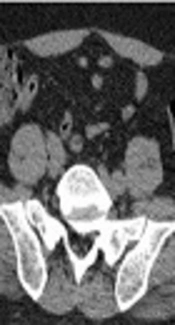 Added Value of Diffusion-Weighted MR Imaging to Non-Enhanced CT in the Evaluation of Acute Appendicitis