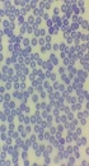 Relapse of a <i>Plasmodium vivax</i> Infection in an Iranian Patient: A Case Report