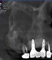 koomesh