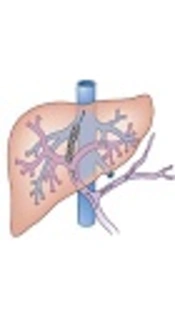 Stent Dysfunction After Transjugular Intrahepatic Portosystemic Shunt: A 14-Year Experience from a Single Tertiary Medical Center