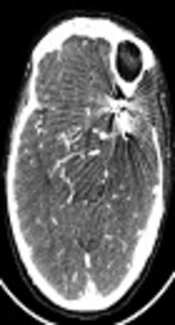 The Diagnostic Value of CT Angiography in the Diagnosis of Residual Aneurysm After Brain Aneurysm Surgery