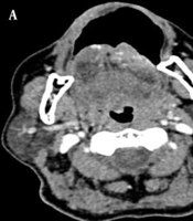 Is a CT Scan Reliable for Determining the Depth of Invasion in Patients with Oral Tongue Squamous Cell Carcinoma? An Original Study and Literature Review