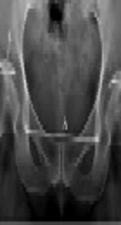 Reliability of a New Radiological Parameter Named the Modified Tönnis Angle for the Evaluation of Acetabular Dysplasia in Adults