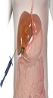 Does Ketamine is Safe and Effective for Procedural Sedation in Percutaneous Liver Biopsy in Children? A Cohort Study in Iran