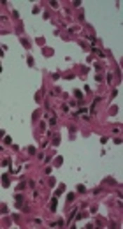 Differentiating Preinvasive from Invasive Lung Adenocarcinoma Appearing as Part-Solid Ground-Glass Nodule Using CT Value and Solid-Part Diameter