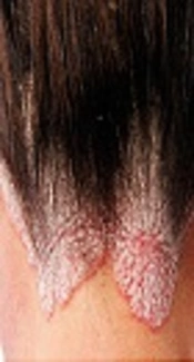 Calcipotriol Plus Betamethasone Versus Betamethasone in Treatment of Scalp Psoriasis in an Iranian Population