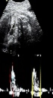 Comparison of Reference Values and Z Scores of Pulse-Doppler Waveforms of Fetal Pulmonary Artery and Aorta