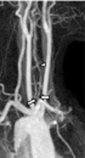 A Case of Duplicated Origin of the Left Vertebral Artery: CTA and MRA Findings and Literature Review