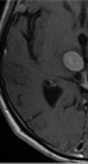 Time-Dependent Changes in the Magnetic Resonance Detection of Brain Metastases Using Single-Dose Gadobutrol