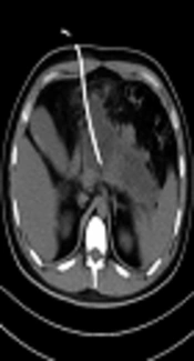 Analysis of the Treatment Efficacy of Percutaneous Catheter Drainage Under CT Guidance for Severe Acute Necrotizing Pancreatitis