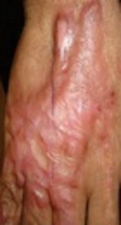 Comparative Effect of Ablative Fractional CO<sub>2</sub> Laser Plus Triamcinolone Acetonide Cream Versus Intralesional Injection of Triamcinolone Acetonide in Keloid and Hypertrophic Scars: A Randomized Clinical Trial