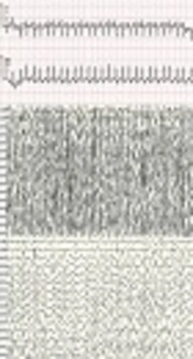 Epilepsies Associated with KCNQ2 Complicated by Supraventricular Tachycardia Due to a De Novo Mutation in KCNQ2