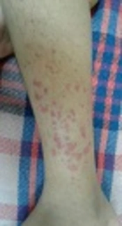 Brucella Endocarditis Along with Leukocytoclastic Vasculitis in a Child: A Case Report