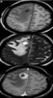 Specific Features of Primary Central Nervous System Lymphoma in Comparison with Glioblastoma on Conventional MRI