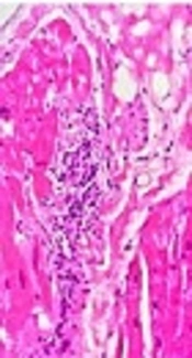Giant Cell Myocarditis: Case Review