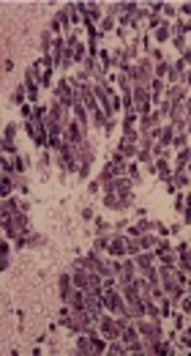 Primary Renal Synovial Sarcoma: Computed Tomography and Magnetic Resonance Imaging Findings