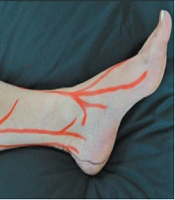 Neurofascial Dextrose Prolotherapy for Managing Chronic Ankle Ligament Injury