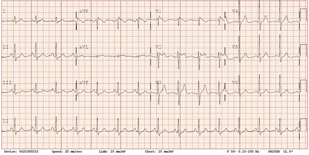 ECG pattern (Brugada syndrome type 2: Saddleback; ST-segment elevated by more than 1 mm and biphasic T wave) ECG pattern (Brugada syndrome type 2: Saddleback; ST-segment elevated by more than 1 mm and biphasic T wave)
