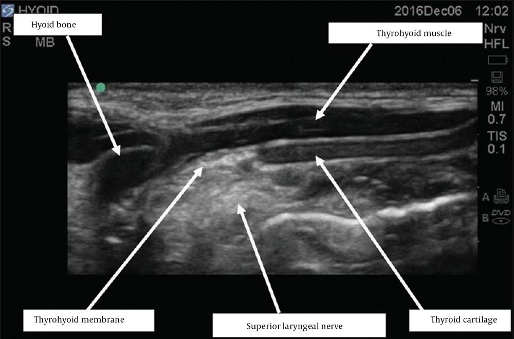The sonographic view of the superior laryngeal nerve block The sonographic view of the superior laryngeal nerve block