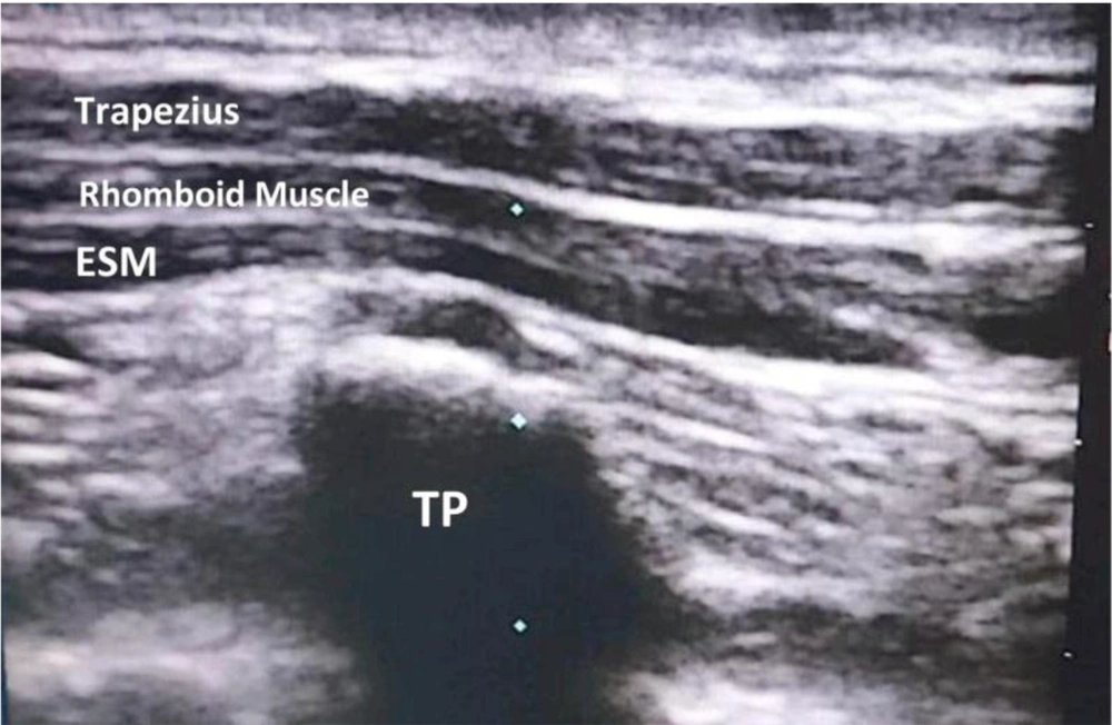 Muscles overlying erector spinae muscles (abbreviations: TP, transverse process; ESM, erector spinae muscle). Muscles overlying erector spinae muscles (abbreviations: TP, transverse process; ESM, erector spinae muscle).