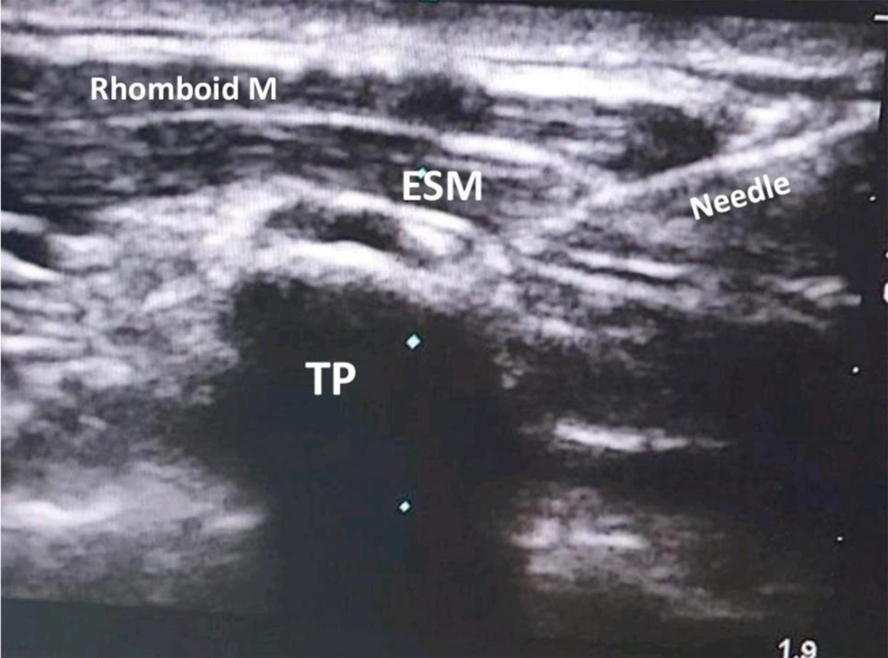 A needle penetrates the muscles until hitting the transverse process (abbreviations: TP, transverse process; ESM, erector spinae muscle). A needle penetrates the muscles until hitting the transverse process (abbreviations: TP, transverse process; ESM, erector spinae muscle).