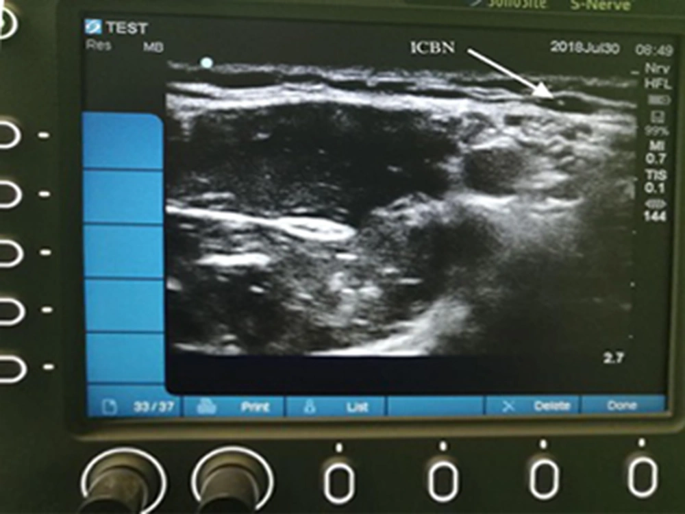 Sonographic view of the intercostobrachial nerve above the deep fascia Sonographic view of the intercostobrachial nerve above the deep fascia