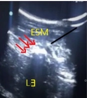 The Analgesic Effects of Preemptive Ultrasound-Guided Pericapsular Nerve Group Block in Comparison with Erector Spinae Plane Block in Elderly Undergoing Hip Arthroplasty: A Randomized Controlled Trial