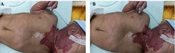 Facing PHACES Syndrome; Anesthesiologist’s Point of View