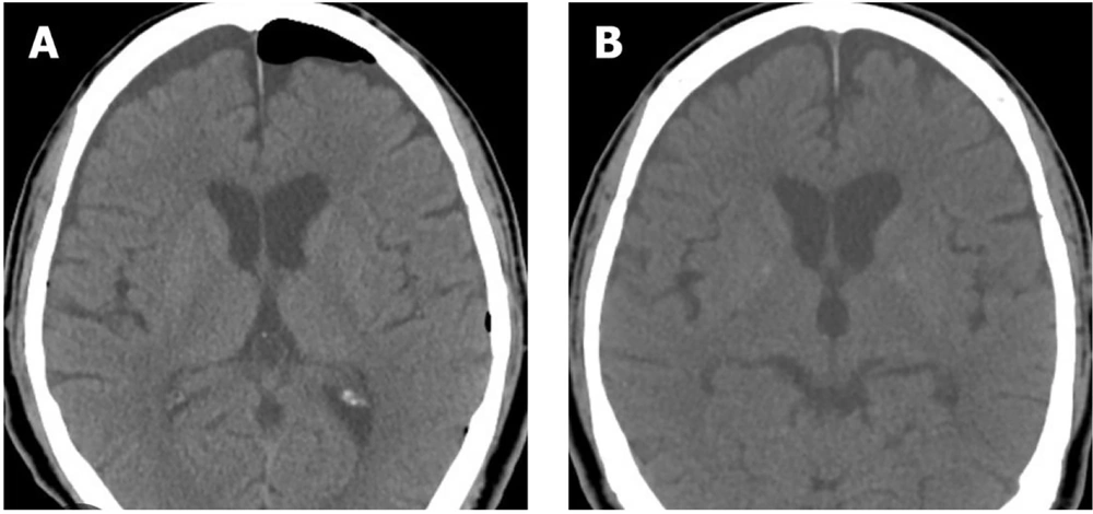 The brain computed tomography (CT) scan; A, before treatment; B, after treatment The brain computed tomography (CT) scan; A, before treatment; B, after treatment