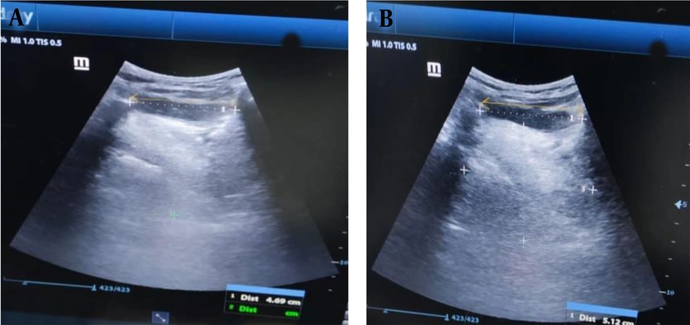 The hyomental distance of the patient in A, a neutral position and B, a fully extended neck (yellow arrow). The hyomental distance of the patient in A, a neutral position and B, a fully extended neck (yellow arrow).