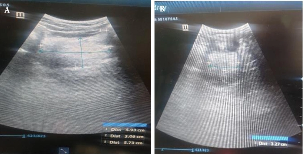 A, Midsagittal cross-sectional area of the tongue and B, the width of the tongue obtained from transverse sonograms (blue arrow). A, Midsagittal cross-sectional area of the tongue and B, the width of the tongue obtained from transverse sonograms (blue arrow).