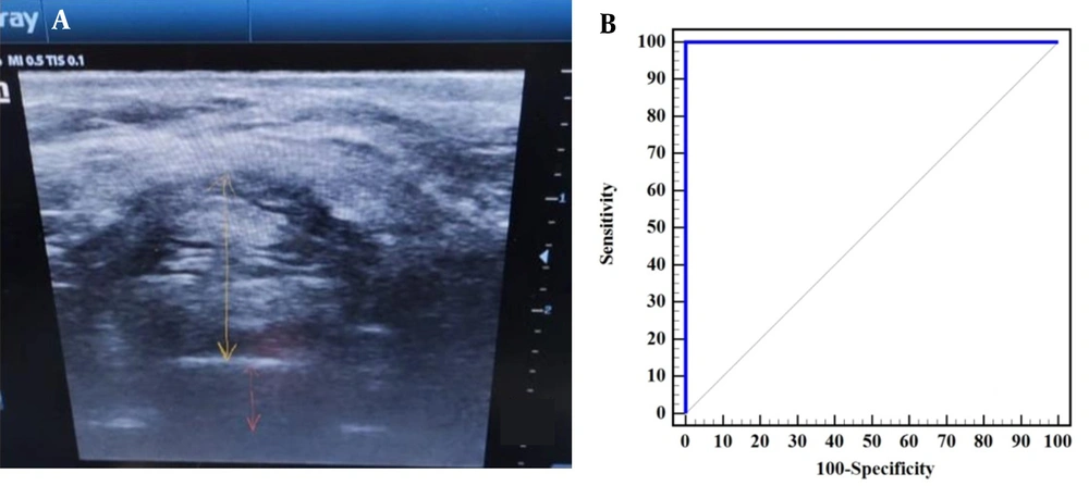 A, the preepiglottic space (yellow arrow) and distance between the epiglottis and a point between the vocal cords (orange arrow), B, ROC curve to predict the ability of ratio of preepiglottic space over the distance between the epiglottis and a point midway vocal cords to differentiate between grade III and grade (I and II) of Cormack-Lehane. A, the preepiglottic space (yellow arrow) and distance between the epiglottis and a point between the vocal cords (orange arrow), B, ROC curve to predict the ability of ratio of preepiglottic space over the distance between the epiglottis and a point midway vocal cords to differentiate between grade III and grade (I and II) of Cormack-Lehane.