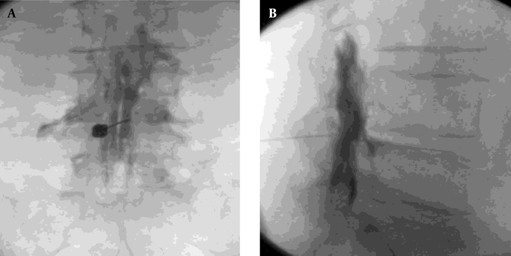 Epidural A, AP view; and B, lateral view after contrast administration Epidural A, AP view; and B, lateral view after contrast administration
