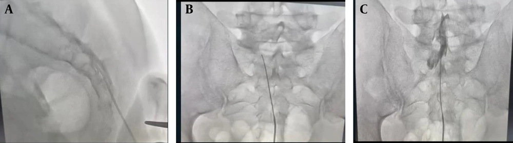 A, entry of Racz catheter; B, Recz catheter in epidural space; and C, Racz catheter after the injection of contrast A, entry of Racz catheter; B, Recz catheter in epidural space; and C, Racz catheter after the injection of contrast