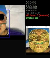 Facial Expression-based Pain Detection: Development and Validation in the Post-anesthesia Care Unit