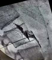 Radiofrequency Ablation for Refractory Palmar and Plantar Hyperhidrosis: A Case Report