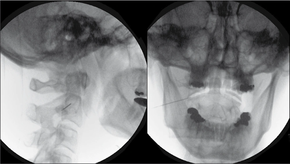 Lateral View With a 5º Oblique Tilt for Initial Needle Entry (Left). Postero-Anterior View (Right) of Needle Entry into Lateral C1/2 Joint. Notice the Active Tip Does Not Contact the Intra-Articular Osseous Surface. Lateral View With a 5º Oblique Tilt for Initial Needle Entry (Left). Postero-Anterior View (Right) of Needle Entry into Lateral C1/2 Joint. Notice the Active Tip Does Not Contact the Intra-Articular Osseous Surface.