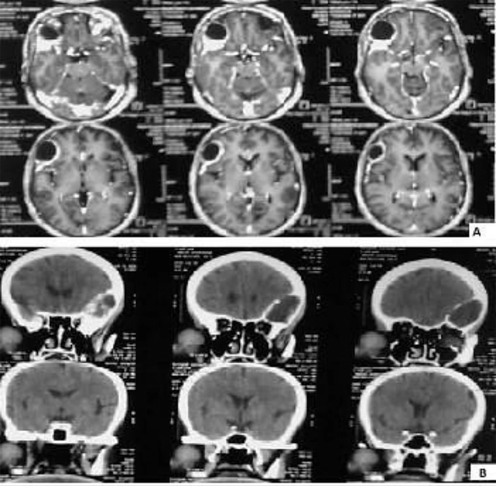 Computed Tomographic Images of the Frontal Bone Cyst Mass Computed Tomographic Images of the Frontal Bone Cyst Mass