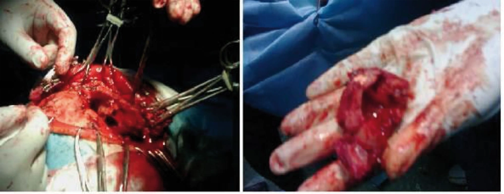 Excisional Biopsy of the Frontal Bone Cyst Mass Excisional Biopsy of the Frontal Bone Cyst Mass