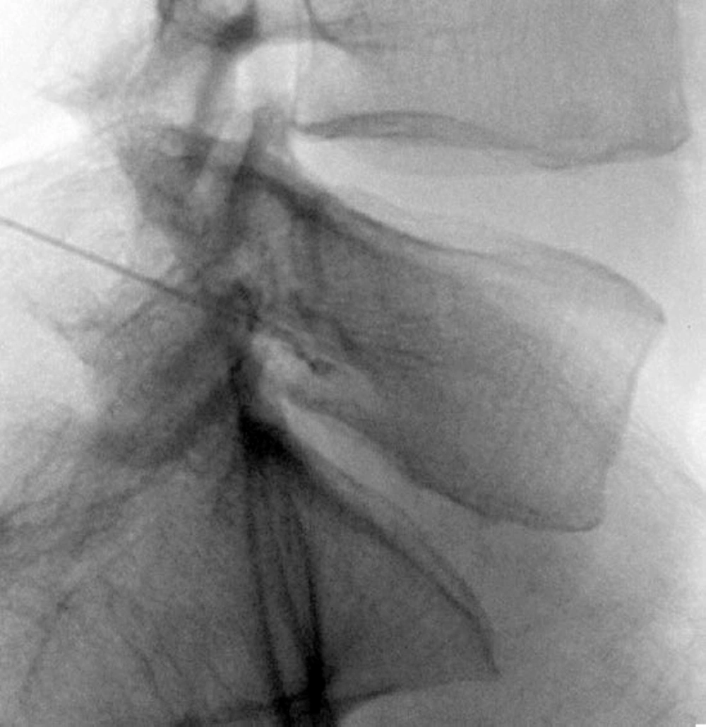 Radiofrequency Needle in Target Point Radiofrequency Needle in Target Point
