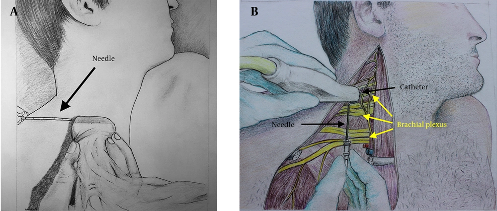 A) In-Plane Approach, B) Out-of-Plane Approach. The Skin Has Been Peeled Away to Show The Underlying Brachial Plexus and Possible Spatial Relationship Between The Catheter After it is Inserted and The Superior Portions of The Plexus A) In-Plane Approach, B) Out-of-Plane Approach. The Skin Has Been Peeled Away to Show The Underlying Brachial Plexus and Possible Spatial Relationship Between The Catheter After it is Inserted and The Superior Portions of The Plexus