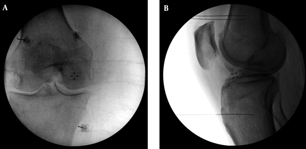 A, Anterior/Posterior and B, Lateral Fluoroscopic Images of the Final Needle Positions During Diagnostic Block Genicular Nerve Blocks are Shown The superior lateral site is identified at the confluence of the lateral femoral shaft and the lateral femoral condyle in the A - P plane and the midpoint of the femur in the lateral plane. The superior medial site is identified at the confluence of the medial femoral shaft and the medial femoral condyle in the A - P plane and the midpoint of the femur in the lateral plane. The inferior medial site is identified at the confluence of the medial tibial shaft and the tibial flare in the A - P plane and the midpoint of the tibia in the lateral plane. Of note, the lateral view (1B) shows some obliquity in which the femoral condyles are not perfectly superimposed. This is ideally avoided. The lateral view during electrode placement (shown in <a href="#fig41648">Figure 2</a>B) represents a more ideal view with no obliquity.