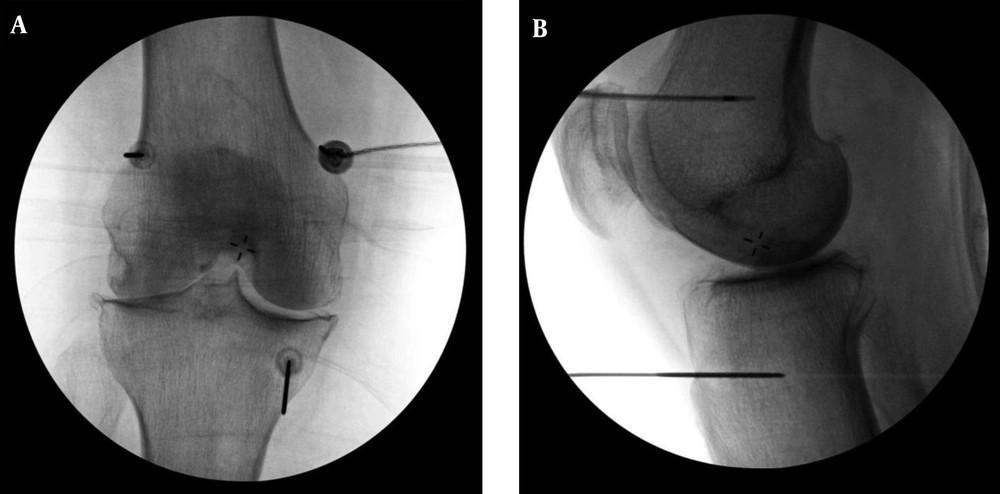 A, Anterior/Posterior and B, Lateral Fluoroscopic Images of the Final Electrode Positions During C-RFA of the Genicular Nerves are Shown Specific final electrode positions are identical to the final needle positions described in the <a href="#fig41647">Figure 1</a> caption.