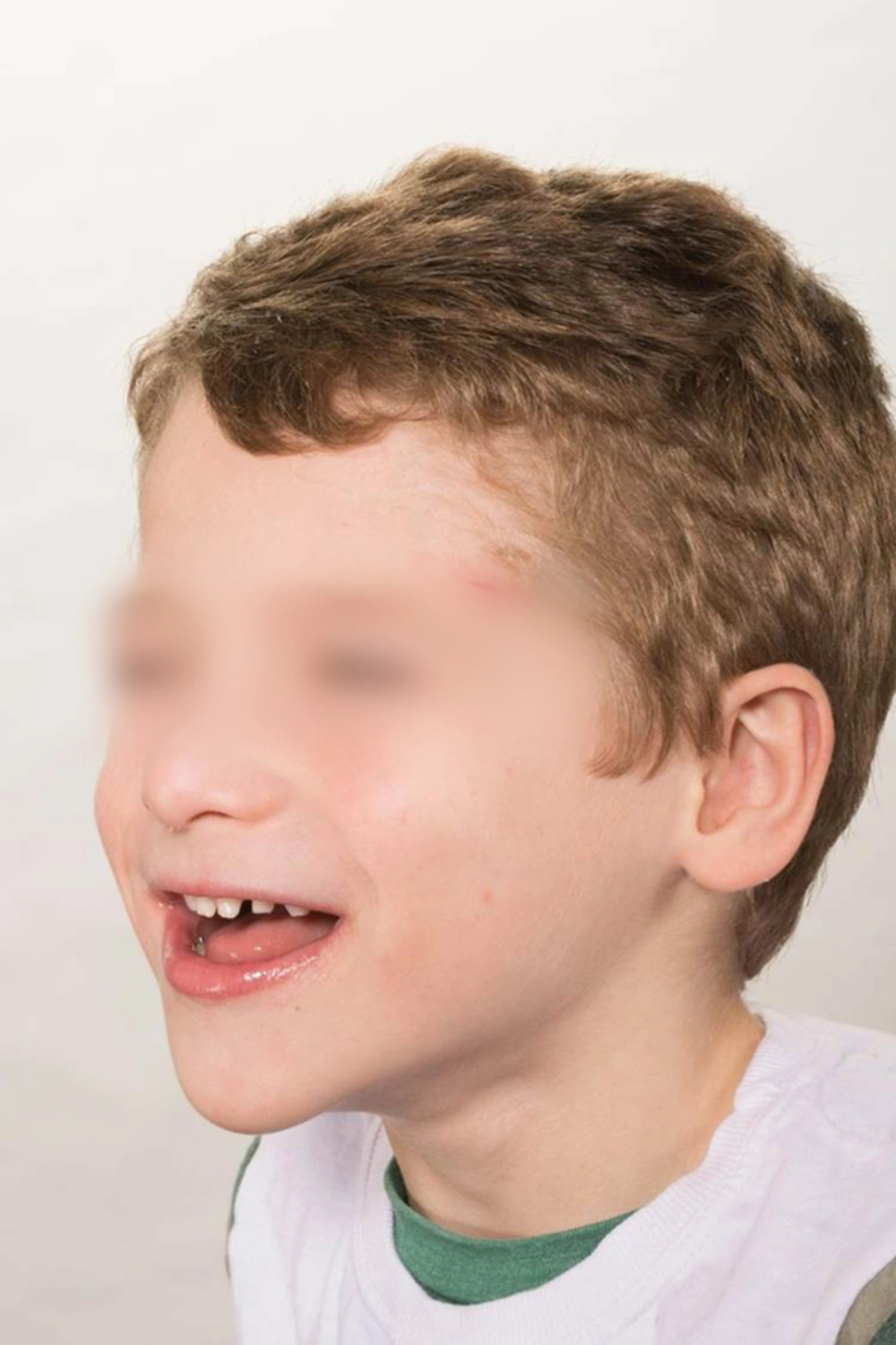 Patients with Angelman Syndrome are Known to Have a Good-Natured Disposition with Frequent Smiling and Laughing, which Can Confound Assessments of Postoperative Pain Patients with Angelman Syndrome are Known to Have a Good-Natured Disposition with Frequent Smiling and Laughing, which Can Confound Assessments of Postoperative Pain