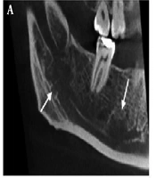 Cover image of the article: A Suspected Metastatic Liposarcoma of the Inferior Alveolar Nerve Canal: A Case Report and Literature Review