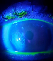 Bioresonance Treatment of Intractable Corneal Ulcer